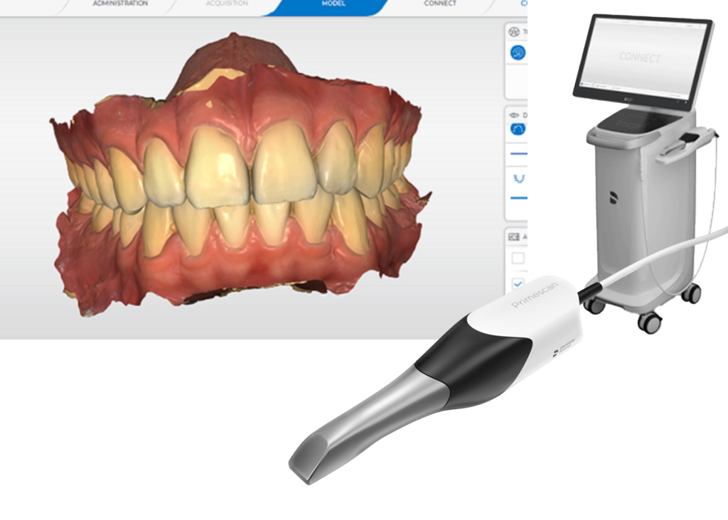 デンツプライシロナの口腔内スキャナー